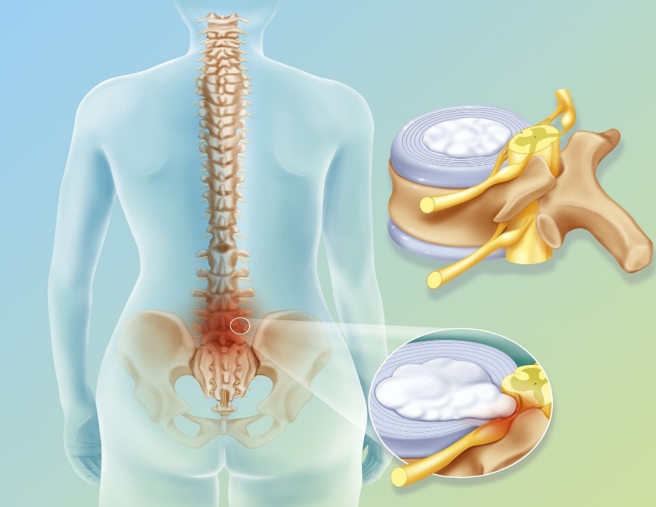 قرص برای پارگی دیسک کمر؛ آیا چنین دارویی وجود دارد؟