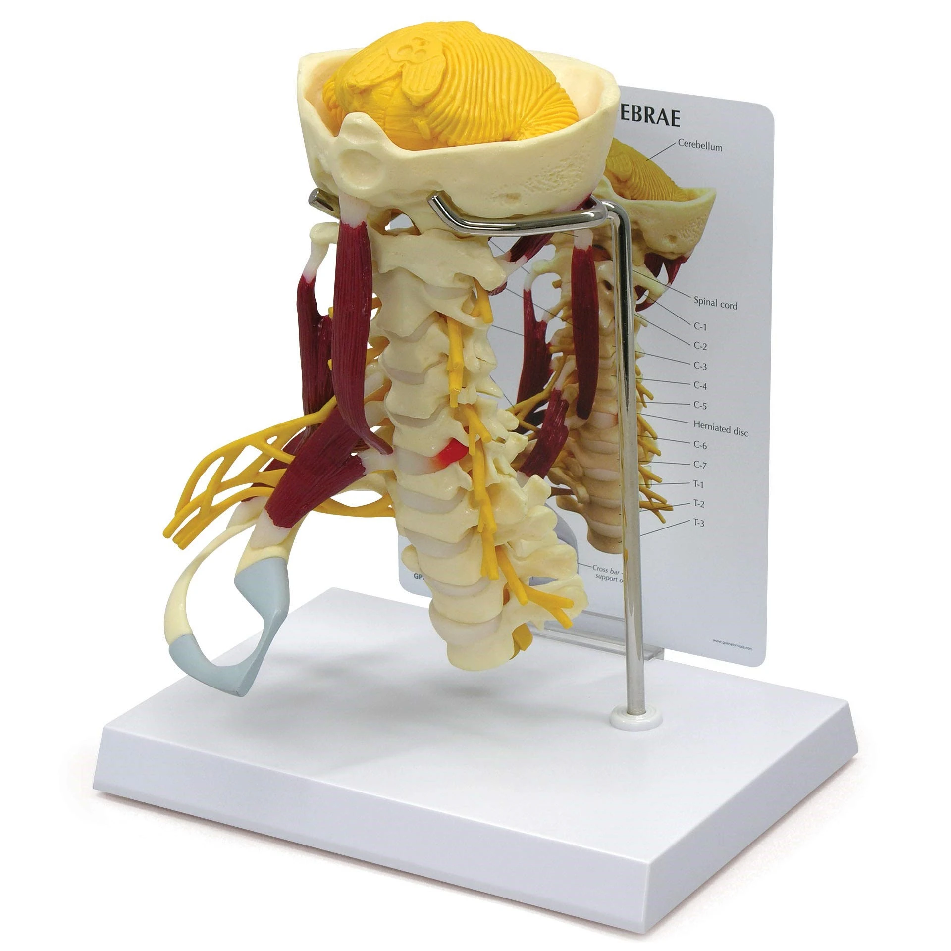 5th-6th-cervical-disc