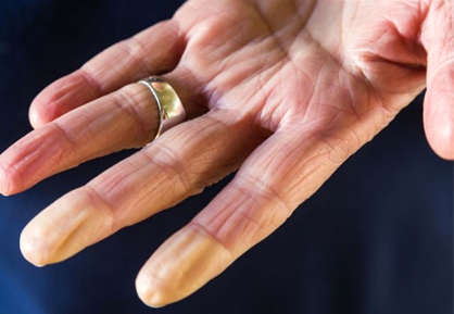 مهمترین عوارض بیحسی نوک انگشتان دست چیست؟